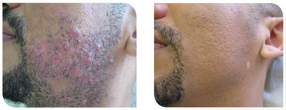 Herbal Aktiv Peel before and after