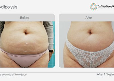 Fat Freezing Body Contouring Treatment