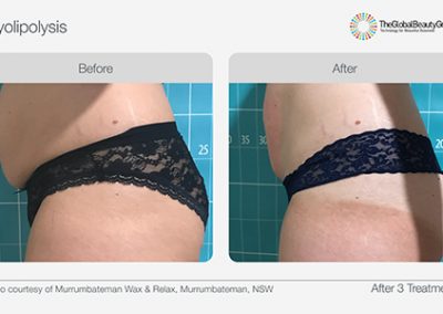 Fat Freezing Body Contouring Treatment