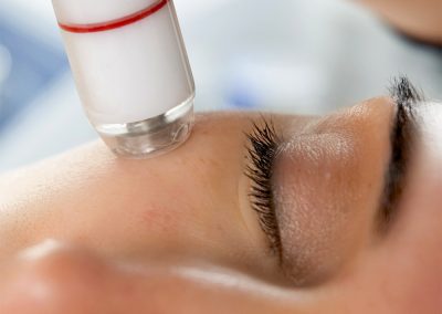 Microdermabrasion-treatment